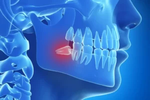 قیمت عمل و جراحی دندان عقل