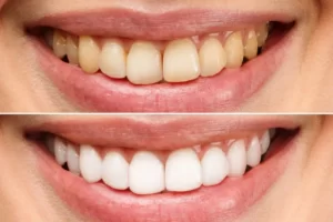 بهترین کامپوزیت دندان برای کدام کشور است؟